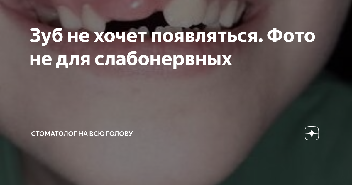 Зуб не хочет появляться. Фото не для слабонервных | Стоматолог на всю ...