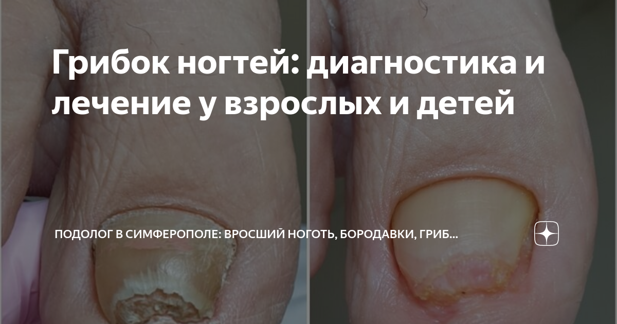 Грибок ногтей: диагностика и лечение у взрослых и детей | Подолог в ...