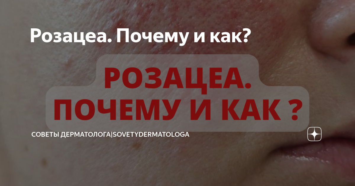 Розацеа. Почему и как? | Советы дерматолога|Sovetydermatologa | Дзен