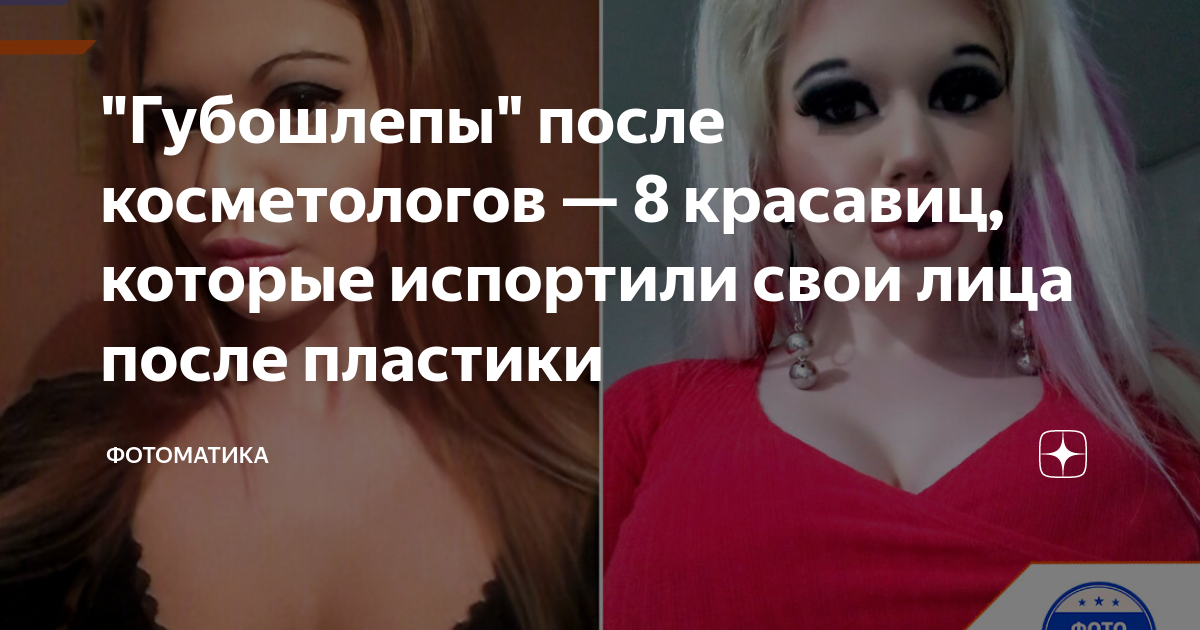 "Губошлепы" после косметологов — 8 красавиц, которые испортили свои ...