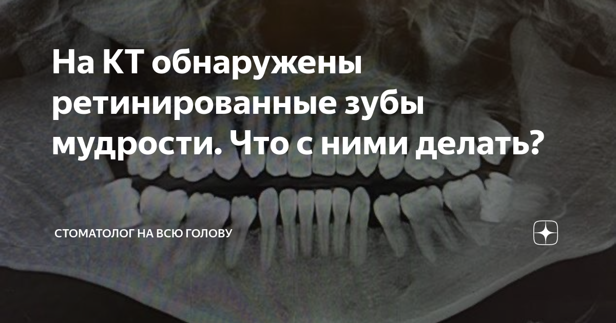 На КТ обнаружены ретинированные зубы мудрости. Что с ними делать ...