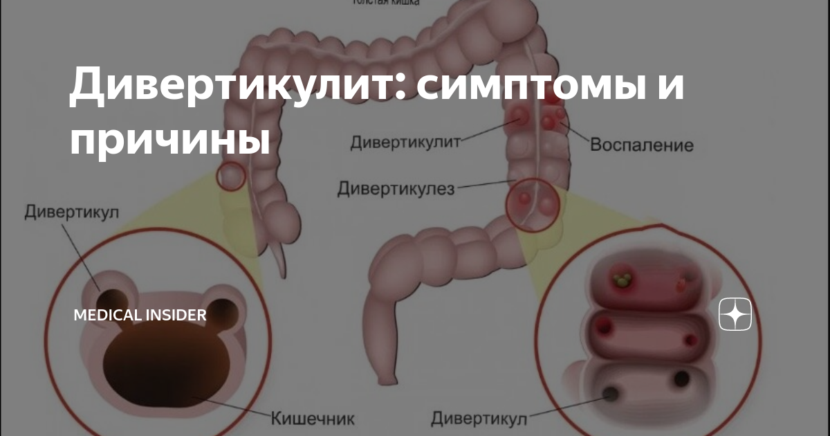 Дивертикулит (дивертикулез): симптомы, лечение, диета