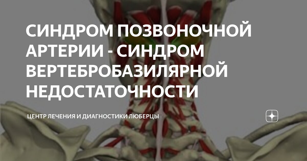 Синдром позвоночной артерии: клинические варианты, классификация, принципы диагностики и лечения