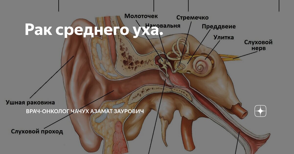 Рак среднего уха. Врач-онколог Чачух Азамат Заурович Дзен Поиск картинок