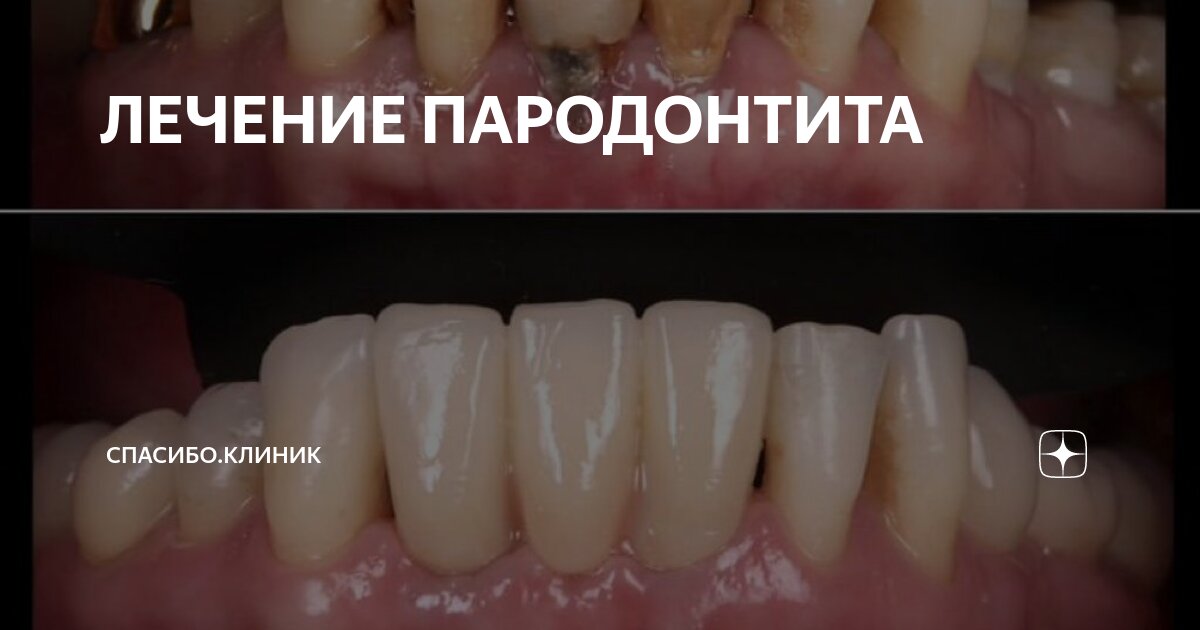 ЛЕЧЕНИЕ ПАРОДОНТИТА | Спасибо.Клиник | Дзен