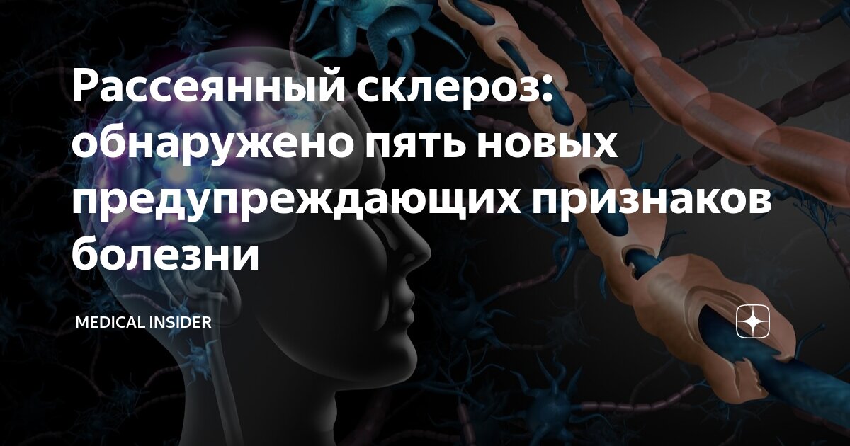 Рассеянный склероз: обнаружено пять новых предупреждающих признаков ...