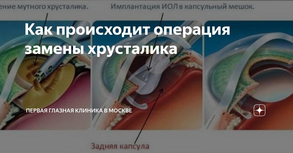операция по удалению катаракты без замены хрусталика