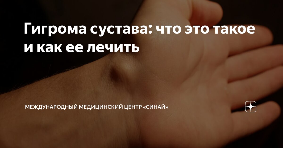 Гигрома сустава: что это такое и как ее лечить | Международный ...