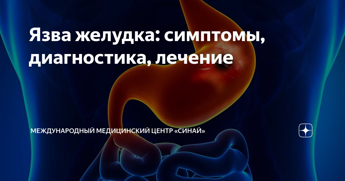 Язва желудка: симптомы, диагностика, лечение | Международный ...