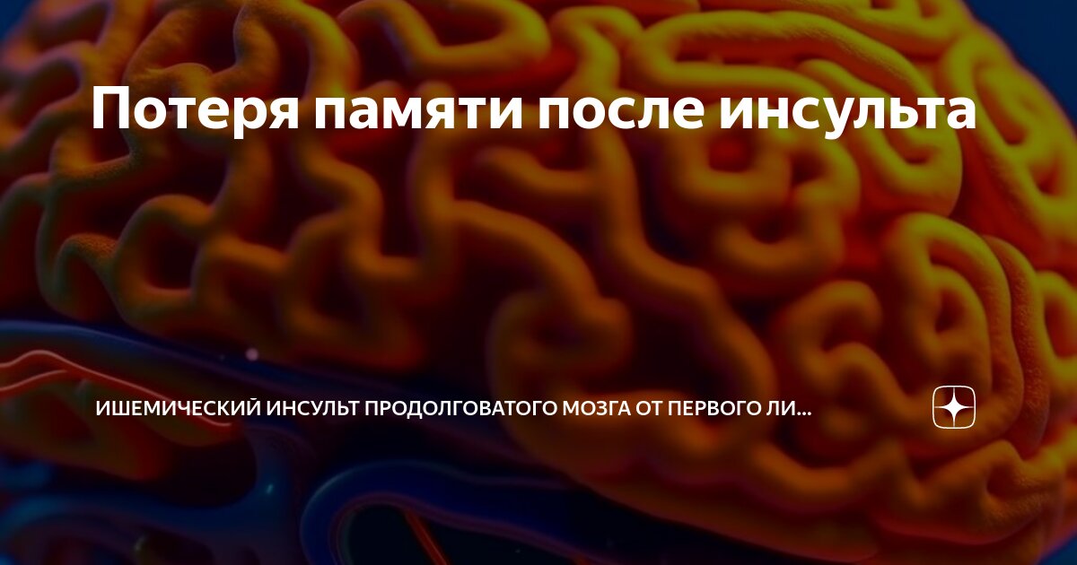 Потеря памяти после инсульта | Ишемический инсульт продолговатого мозга ...