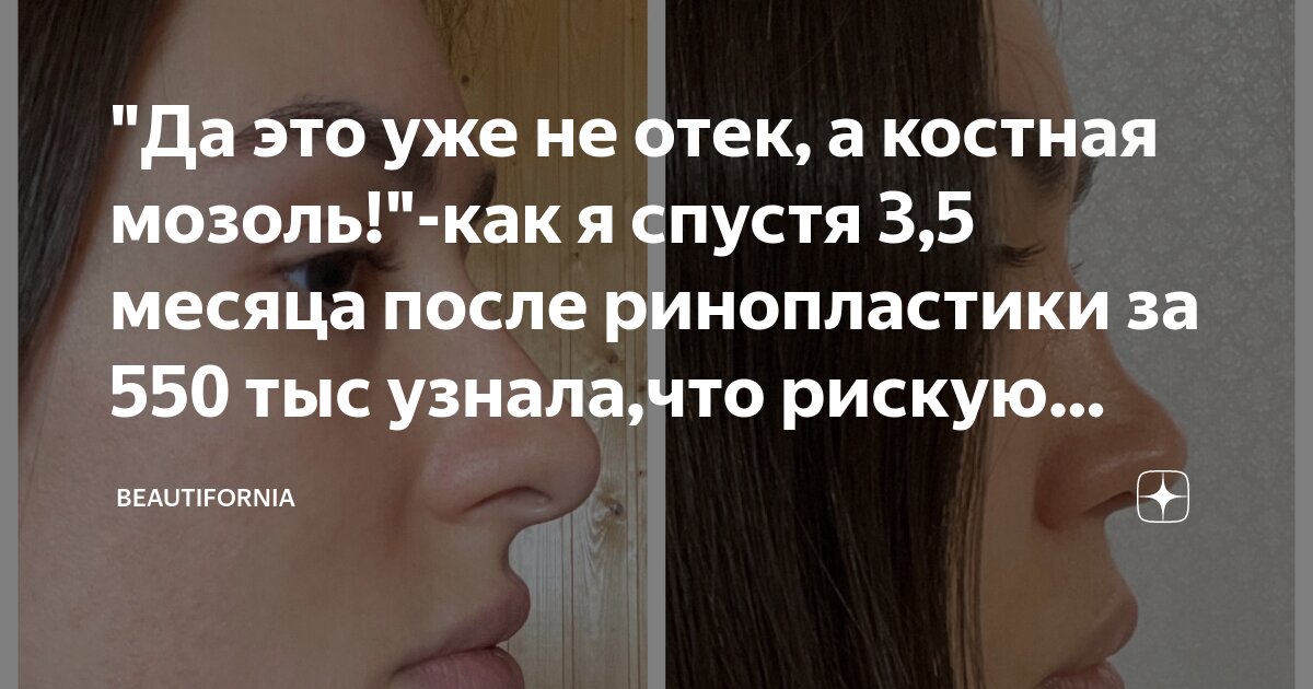 Как выглядит костная мозоль после ринопластики Костная мозоль после ринопластики