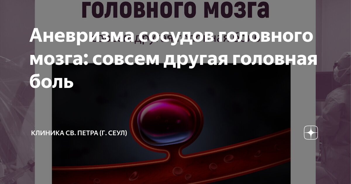 Аневризма сосудов головного мозга: совсем другая головная боль ...