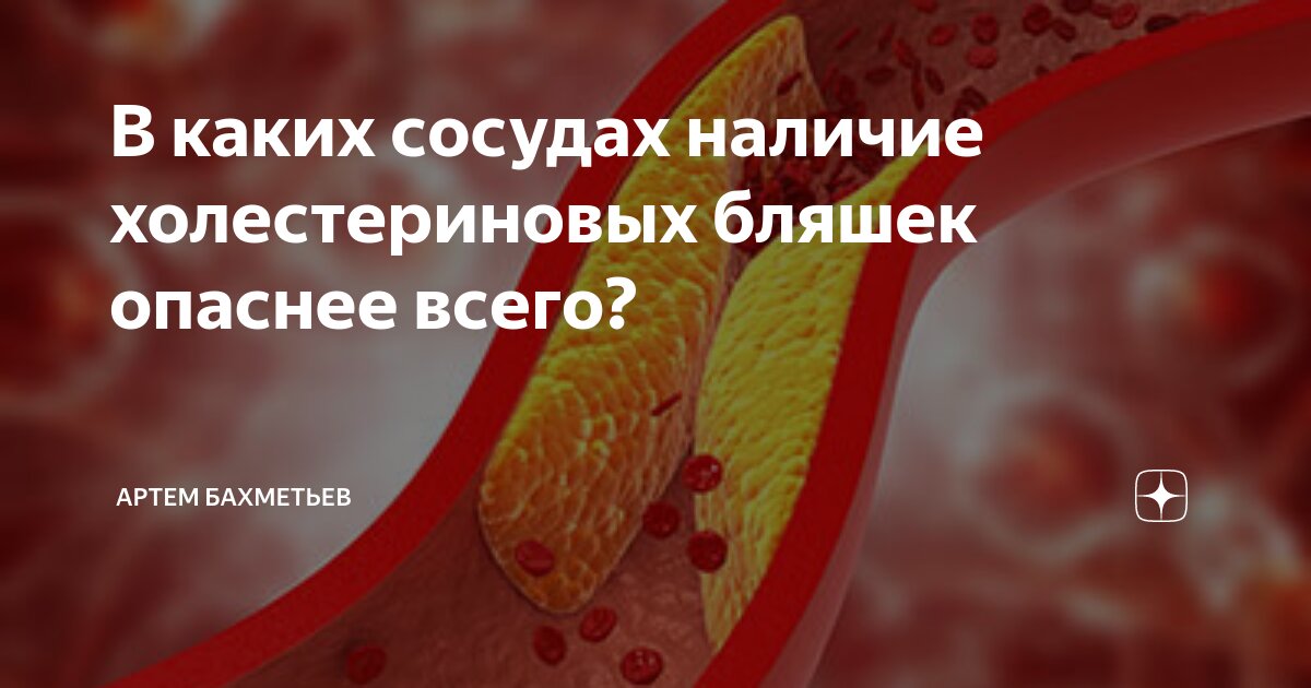 В каких сосудах наличие холестериновых бляшек опаснее всего? | Блог ...
