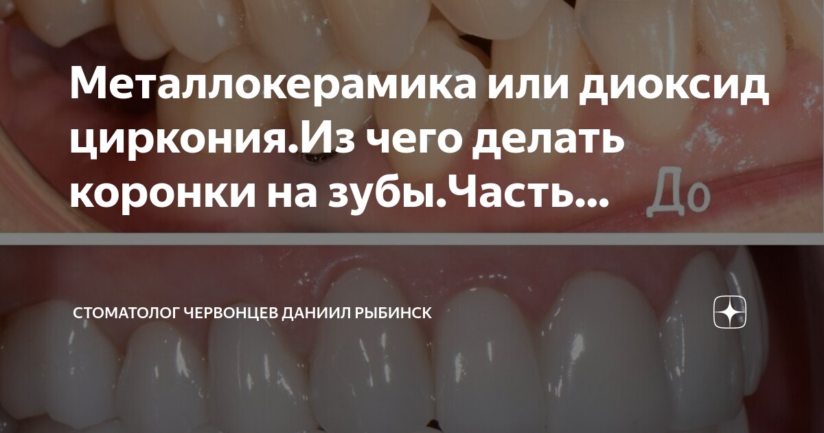 Металлокерамика или цирконий Металлокерамика или цирконий