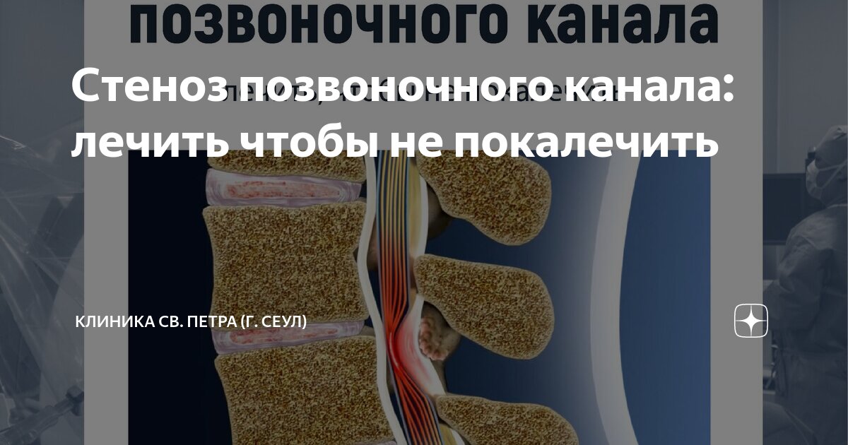 Стеноз позвоночного канала: лечить чтобы не покалечить | Клиника св ...