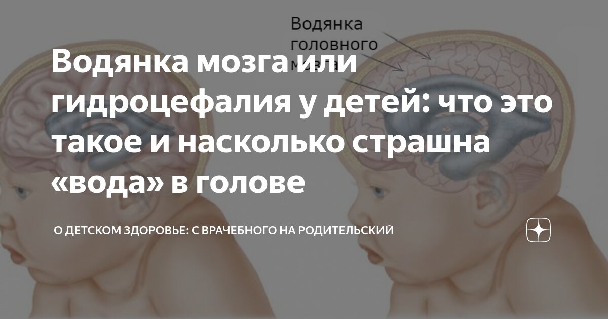 Гидроцефалия у детей. Лечение гидроцефалии головного мозга у детей