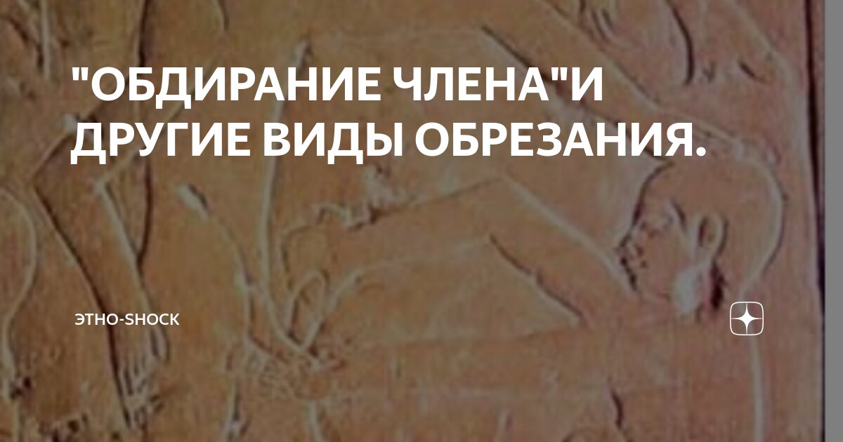 Виды обрезания крайней плоти. Виды обрезания крайней плоти. Классификация фимоза у детей. Обрезание у мужчин схема как выглядит. Крайняя плоть после обрезания.