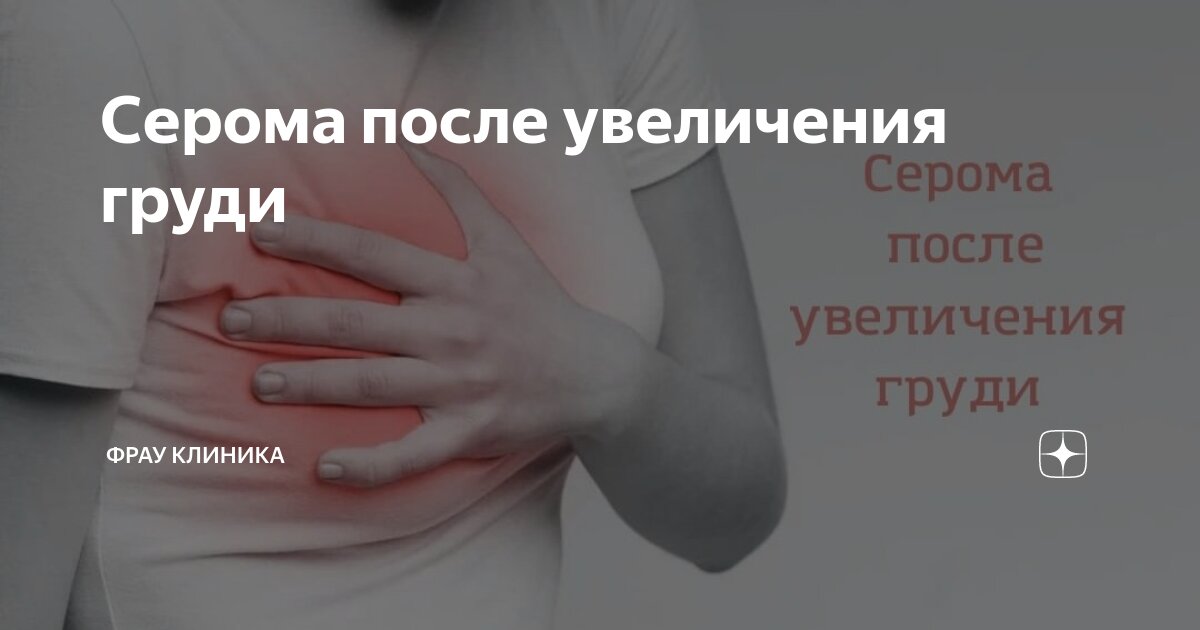 Серома после маммопластики поэтапно