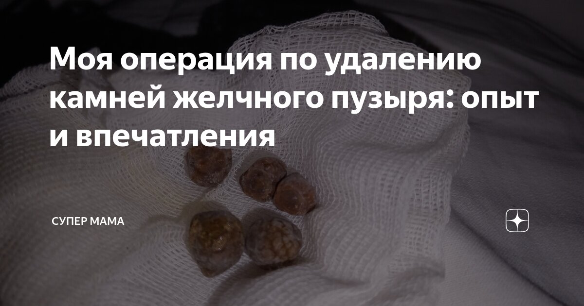 Моя операция по удалению камней желчного пузыря: опыт и впечатления ...