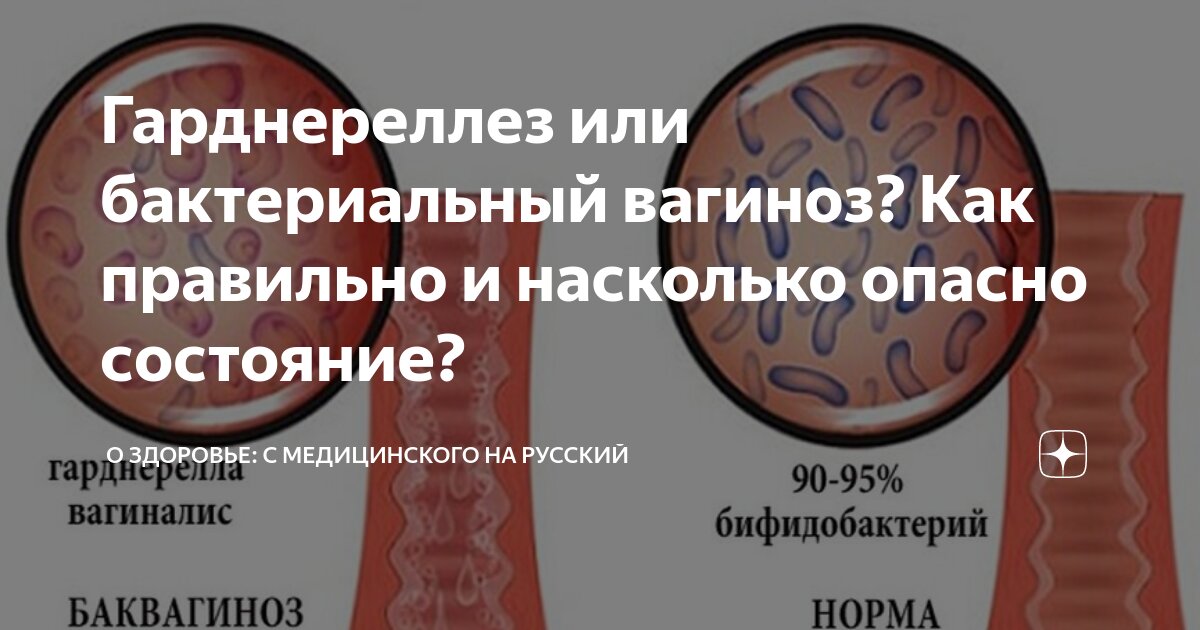 Бактериальный вагиноз - причины появления, симптомы, диагностика и лечение