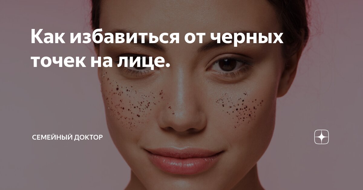 Как избавиться от черных точек на лице. | Семейный доктор | Дзен
