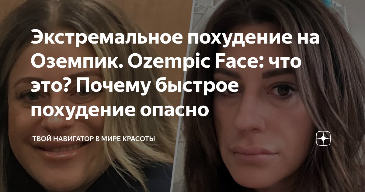 Экстремальное похудение на Оземпик. Ozempic Face: что это? Почему ...