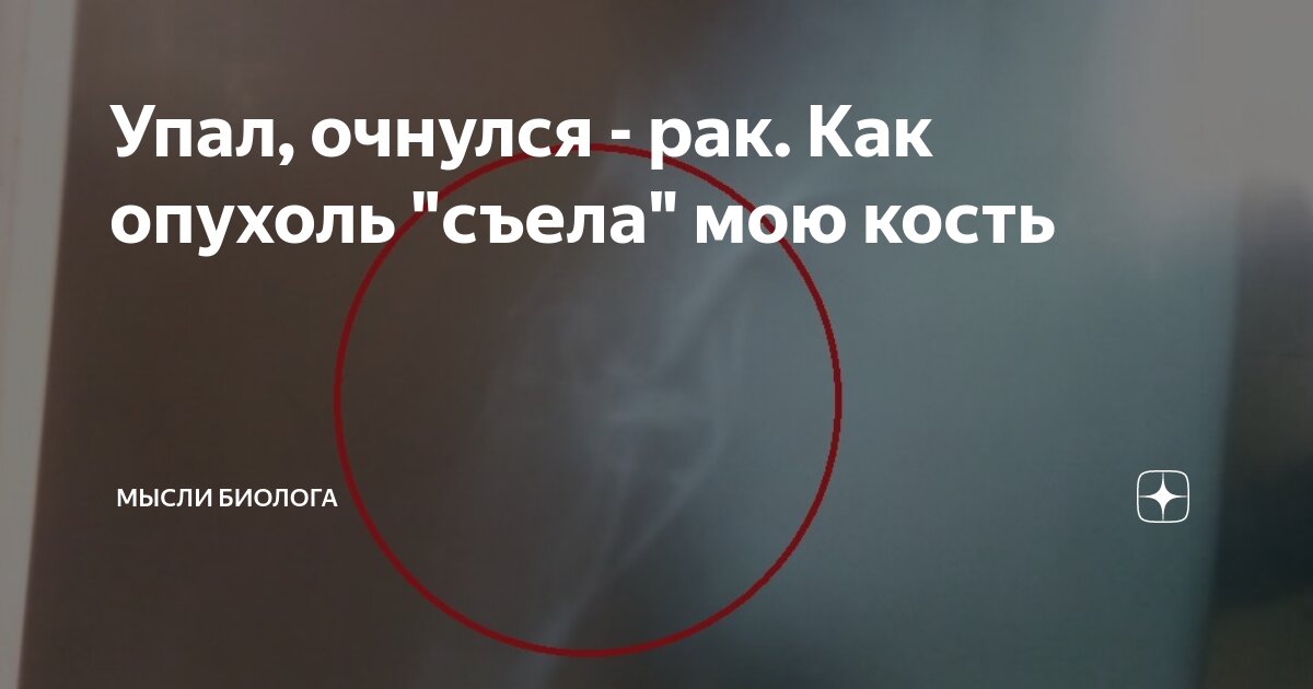 человекпададет с лестницы. девушка упала с лестницы. пробитие лестницы в подъезде. обвалилась лестница в подъезде. упал на лестнице сломал руку.