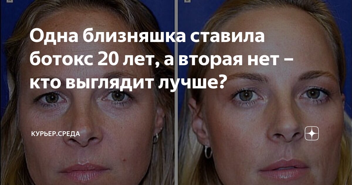 Ботокс для лица до и после. Ботокс в 50 лет. Ботокс в 50 лет. Круговая подтяжка лица в старости. Ботокс лица после 50 лет.