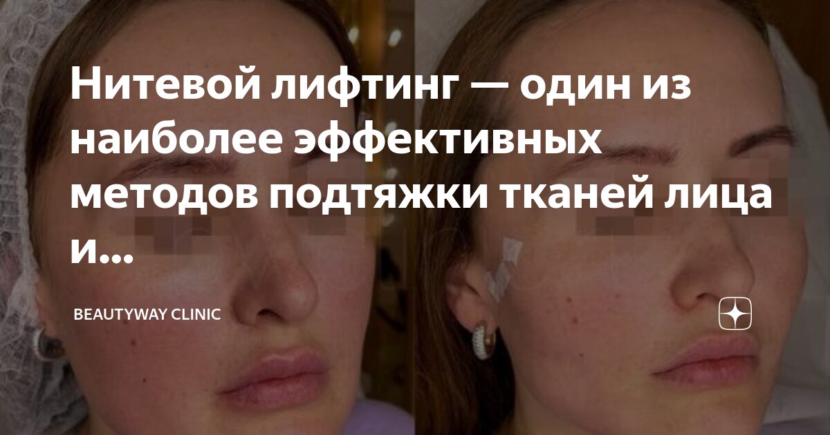 хирургическая круговая подтяжка лица. кругован подтнгка лица. круговая подтяжка лица до и после. омоложение лица. круговая пластика лица с подтяжкой.