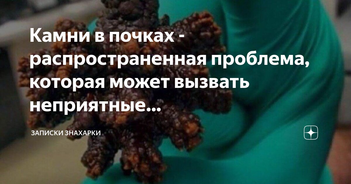 Можно ли кофе при камнях в почках. Можно ли кофе при камнях в почках