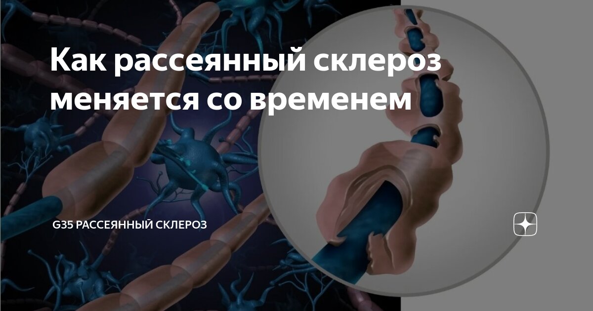 став рассеянный склероз