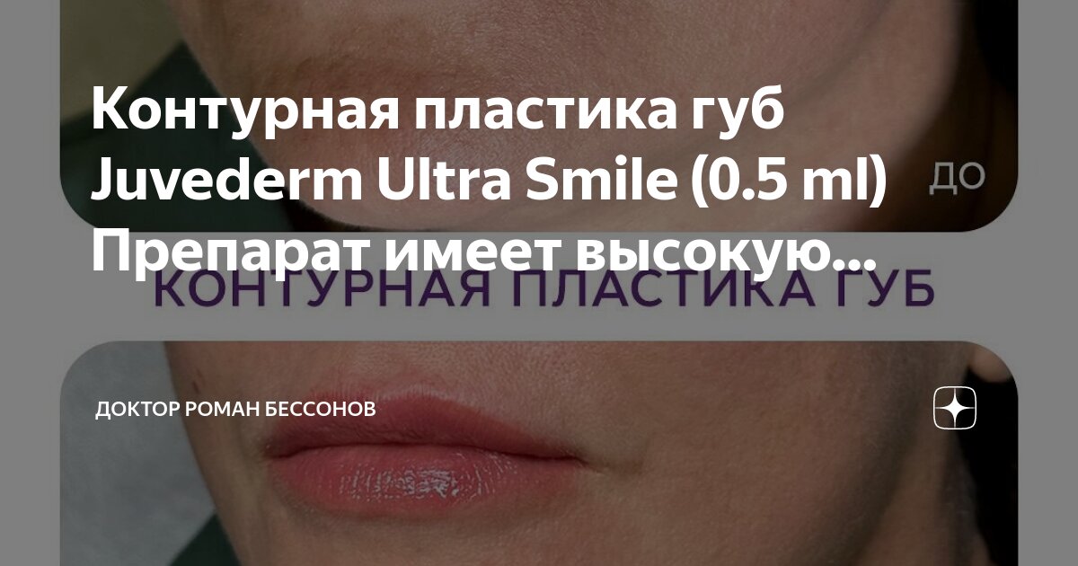 Рефрешинг губ гиалуроновой кислотой. Губа д р. Stylage m для губ 1 мл до и после. Губы с ботоксом до и после. Увеличенные губы красивые.