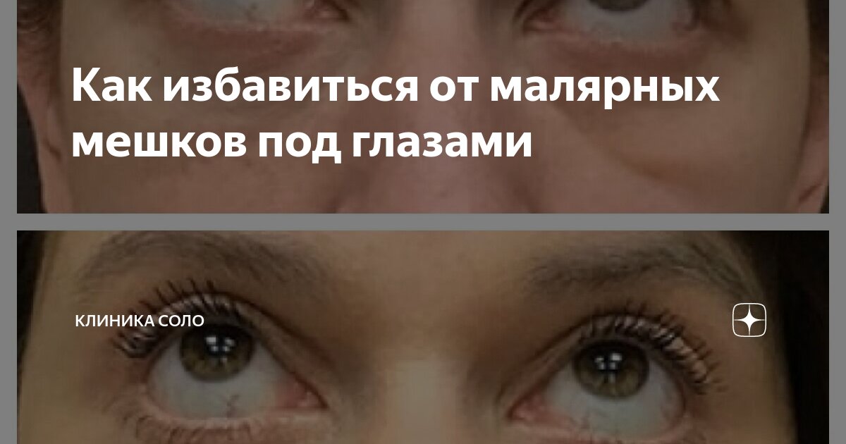 как избавится от мешков под глазами мужчине