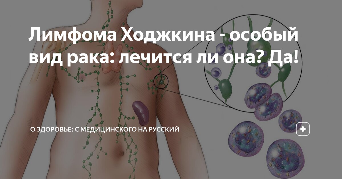 Лимфома Ходжкина - особый вид рака: лечится ли она? Да! | О здоровье: с ...
