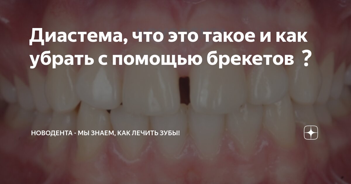 диастема до и после брекетов