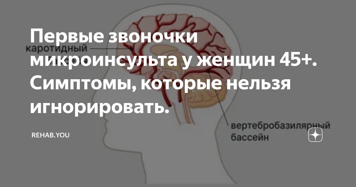 Первые звоночки микроинсульта у женщин 45+. Симптомы, которые нельзя ...