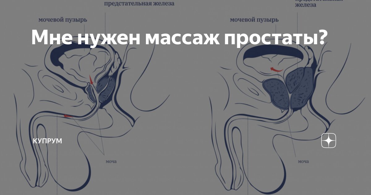 Массаж простаты при лечении предстательной железы