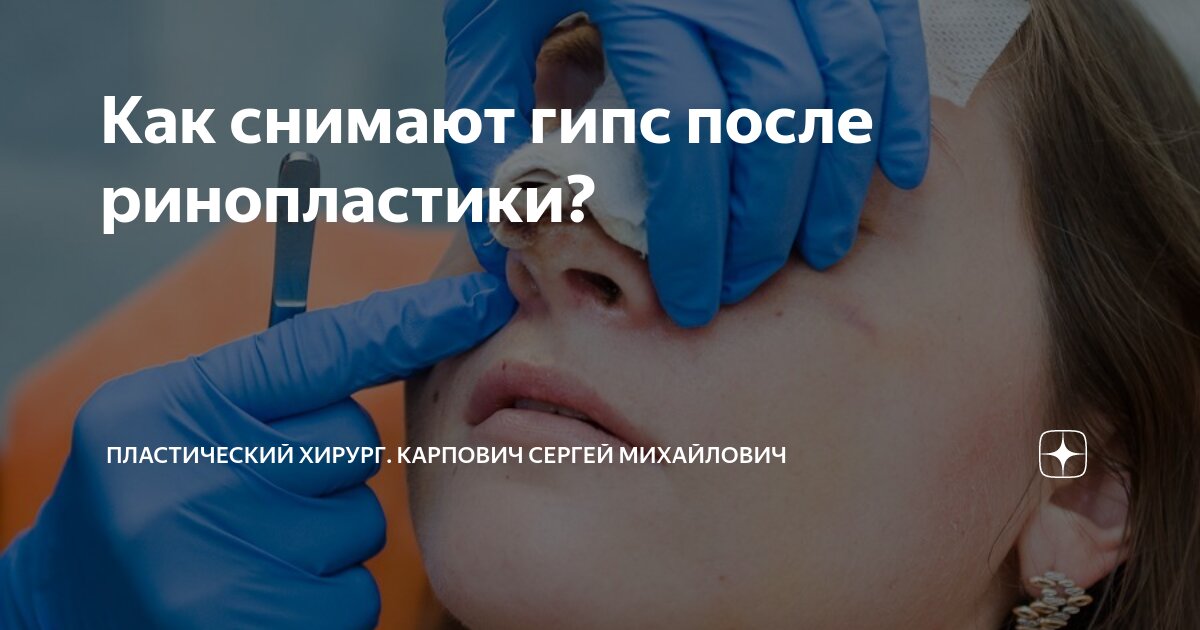 Когда сойдут отеки после ринопластики?