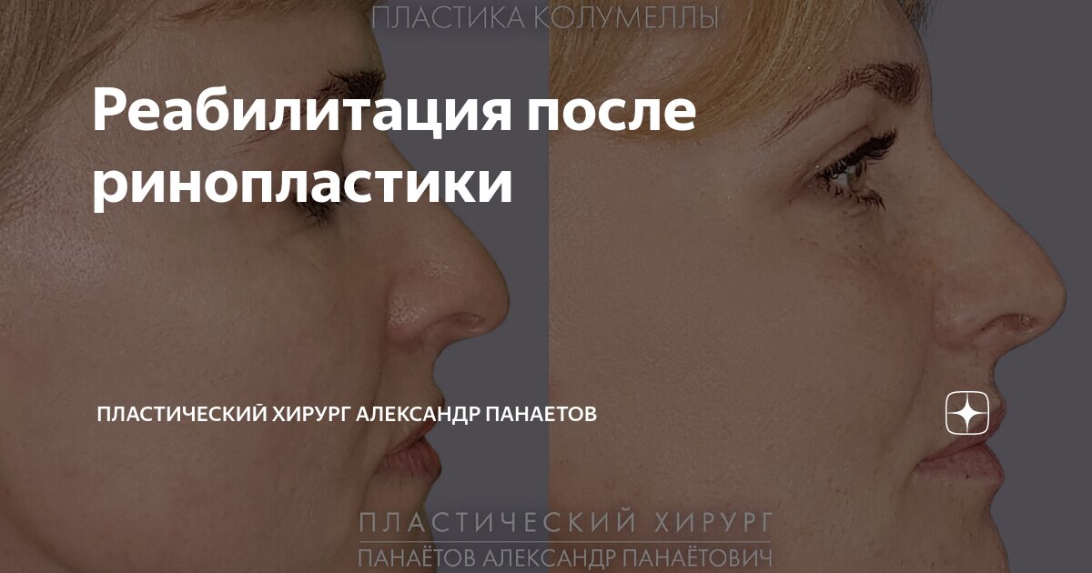 #спать после открытой ринопластики - online консультации пластического хирурга Баулина