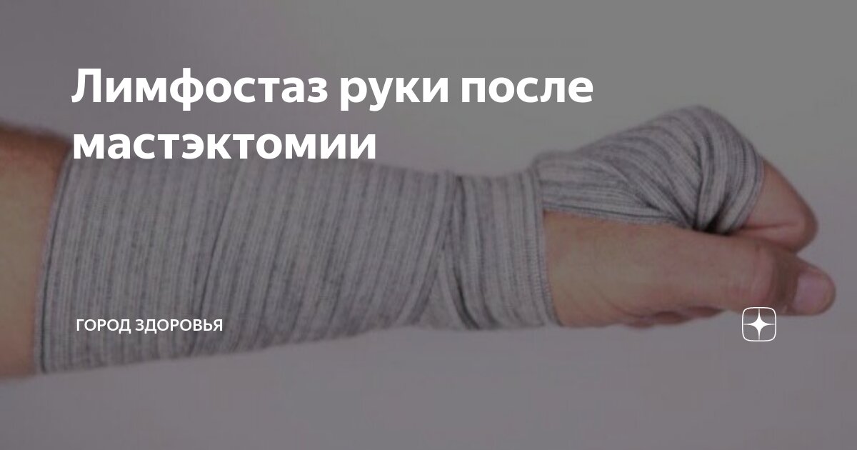 Лимфостаз руки после мастэктомии | Город Здоровья | Дзен