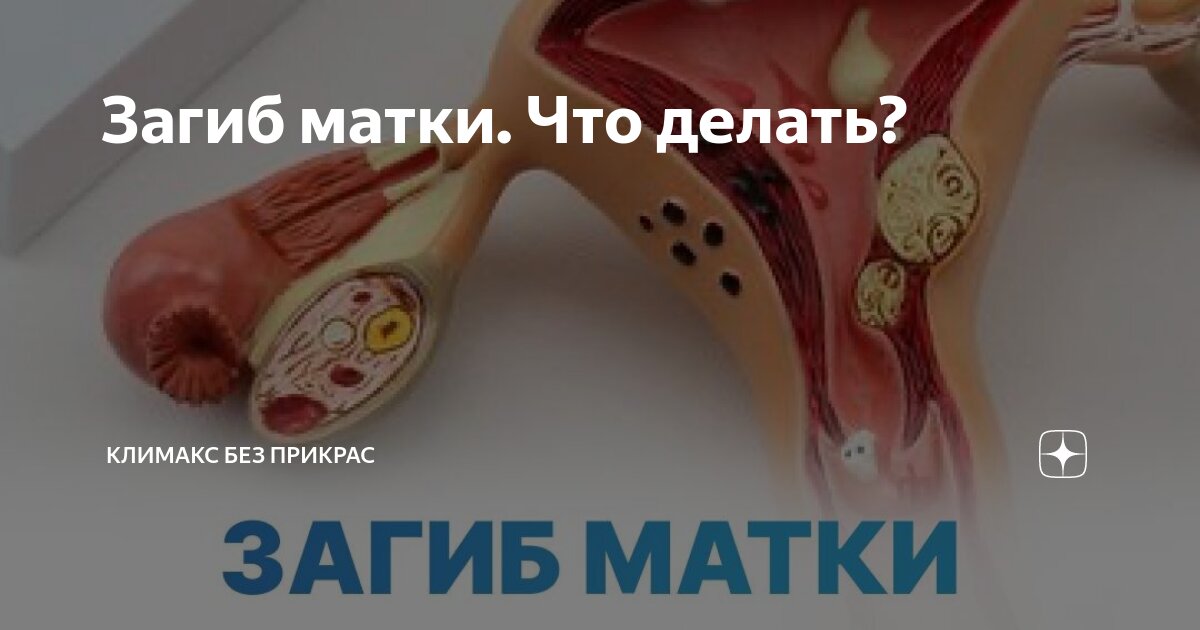 Причины загиба матки, клиническая картина, тактика лечения, риски