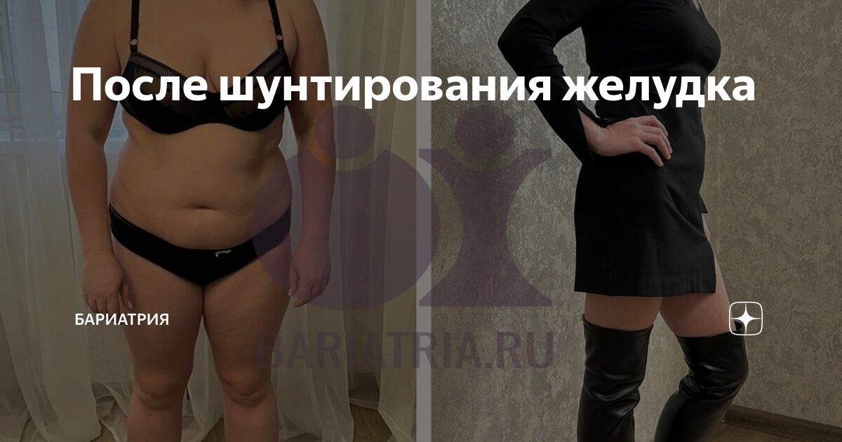 После шунтирования желудка | Бариатрия | Дзен