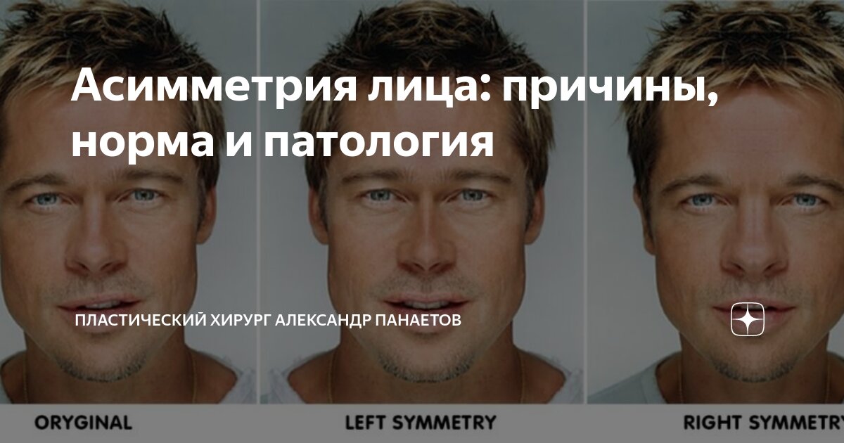 Как выглядит ассиметричное лицо Асимметрия лица: причины, норма и патология Пластический хирург Александр Панает
