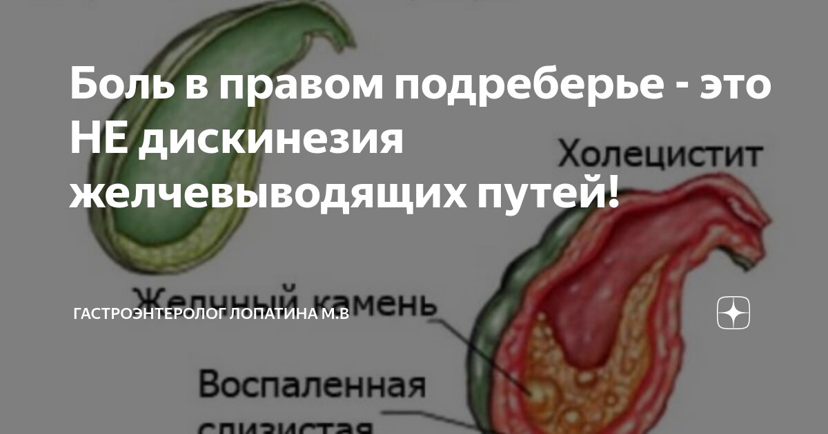 Боль в правом подреберье - это НЕ дискинезия желчевыводящих путей ...