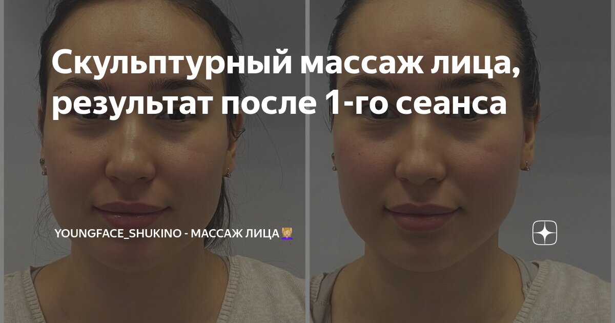 Скульптурный массаж лица, результат после 1-го сеанса | youngface ...