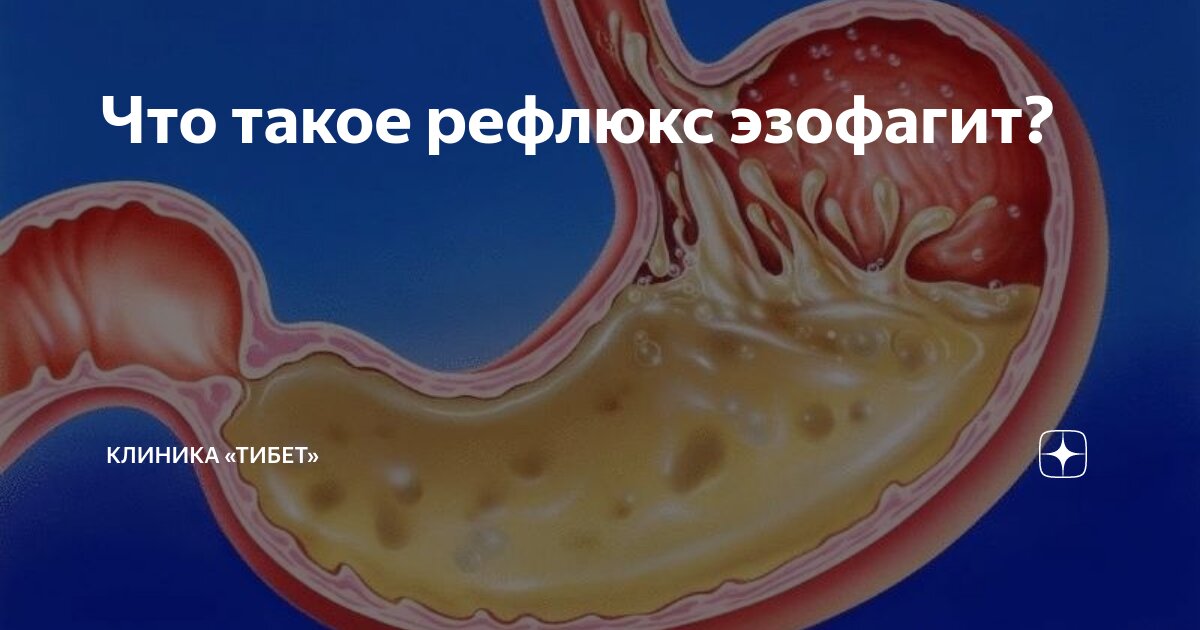 как лечить рефлюксный эзофагит