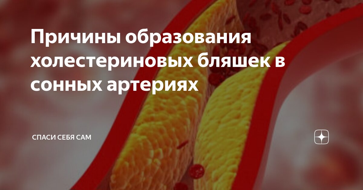Причины образования холестериновых бляшек в сонных артериях | Спаси ...