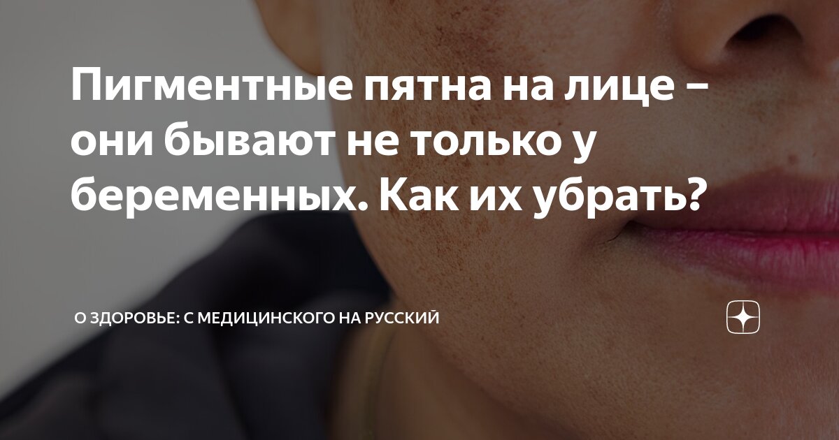 Пигментные пятна на лице – они бывают не только у беременных. Как их ...