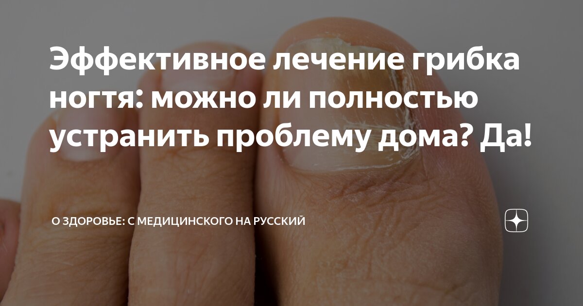 Эффективное лечение грибка ногтя: можно ли полностью устранить проблему ...