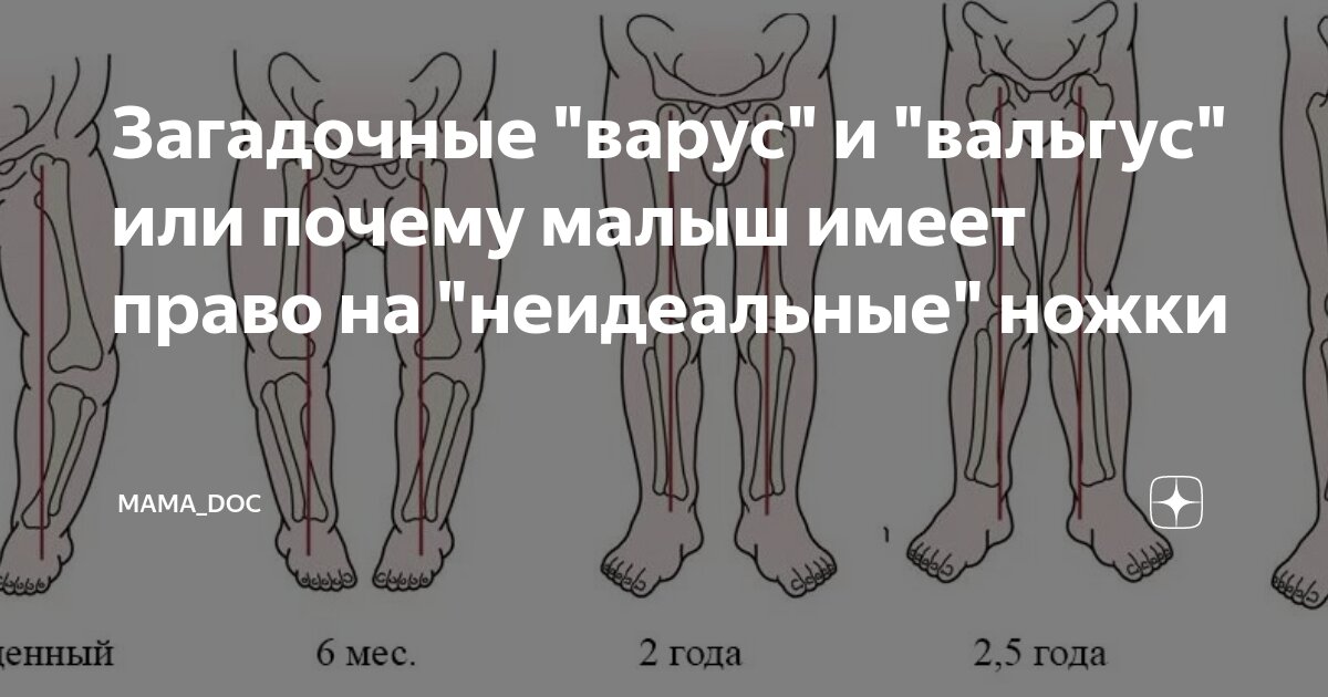 Загадочные "варус" и "вальгус" или почему малыш имеет право на ...